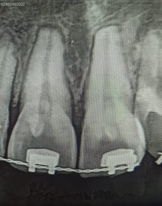 Management of Traumatized Central Incisor - Clinical result