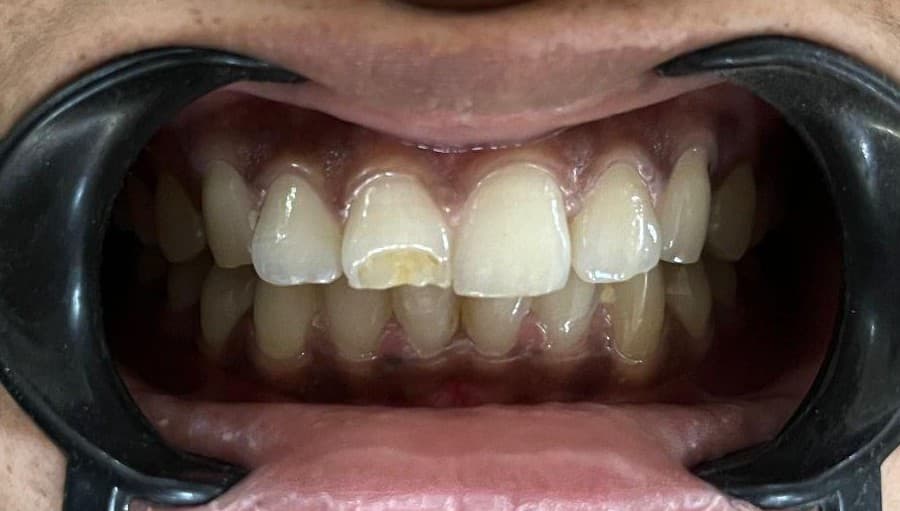 Class IV Incisal Composite Build-Up - Clinical result