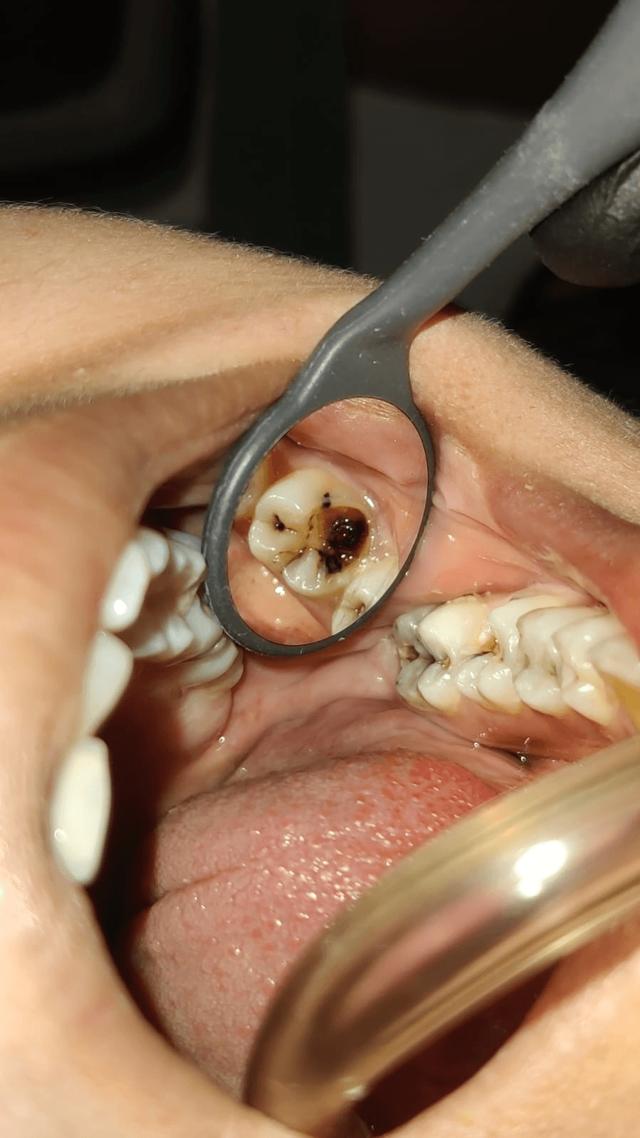 Restoration of Occlusal Anatomy - Clinical result