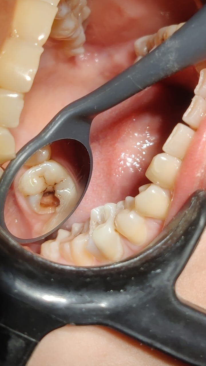 Endodontic Management of Radix Entomolaris - Clinical result