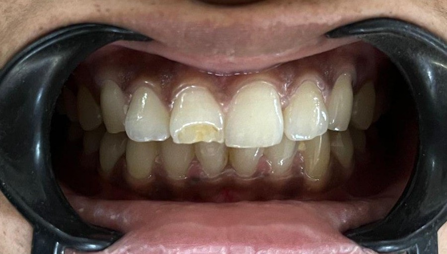 Class IV Incisal Composite Build-Up - Clinical result